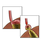 GERD and Hiatal Hernia, Illustration