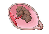 Foetus with Microcephaly, Illustration