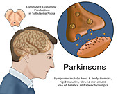 Dopamine & Parkinson's, Illustration
