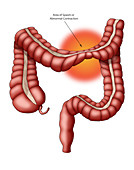 Irritable Bowel Syndrome (IBS), Illustration