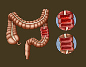 Colitis and the Large Intestine, Illustration