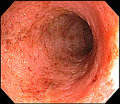 Moderate Ulcerative Colitis
