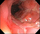 Severe Crohn's Disease