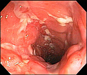 Severe Crohn's Disease