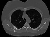 Metastatic Breast Carcinoma, CT Scan