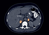 Von Hippel-Lindau Pheochromocytomas, CT