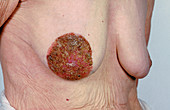 Paget Disease of Breast