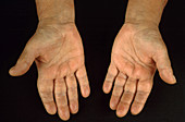 Hypothyroidism, Hands