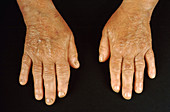 Hypothyroidism, Hands
