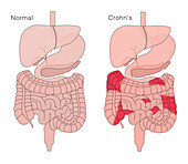 Healthy Digestive System and Crohn's Disease