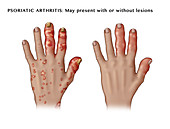 Psoriatic Arthritis with and without Lesions