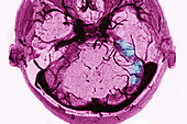 Thrombosis of Venous Sinuses, Dura Mater, MRI