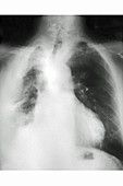Lung Cancer, X-Ray