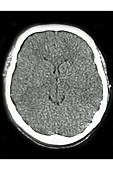 Cerebral Edema, CT Scan