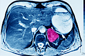 Malignant Adrenocortical Tumour, CT Scan