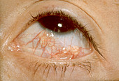 Golfball-related Ocular Injury