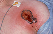 Infected Pacemaker