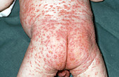 Infant with Chicken Pox