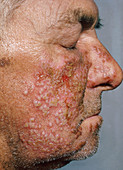 Herpes Simplex Virus