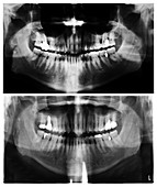15 Year Mouth Comparison, X-Rays