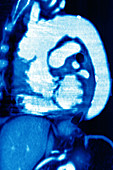 Aortic dissection, CT MRI