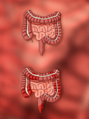 Healthy Intestine & Crohn's Disease