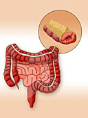 Crohn's Disease, Illustration