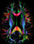 White matter brain tracts, DTI