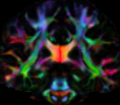 White matter brain tracts, DTI