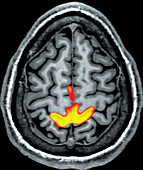 Motor Task (feet and toes), fMRI