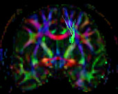 Superior Frontal Occipital Fasciculus, DTI