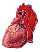 Aortic Dissection, Illustration