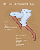 Restless Leg Syndrome, Illustration