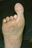 Extra large toe