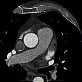 Left Atrial Appendage Clot, CT Scan
