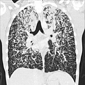 Aspergillosis, CT scan