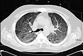 Viral pneumonia, CT scan