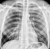Normal chest X-ray