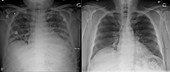 Viral pneumonia vs. normal chest X-rays