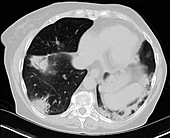 Eosinophilic pneumonia, CT scan
