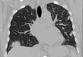 Eosinophilic pneumonia, CT scan