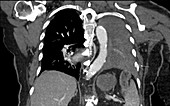 Hemothorax post trauma, CT scan