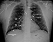 Normal chest X-ray with labels