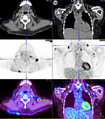 Supraclavicular lymphoma, PET-CT scan