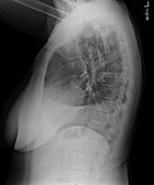 Pleural effusion, X-ray