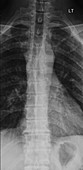 Sternal angle T4-5 X-ray