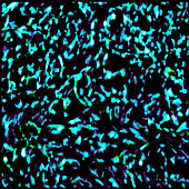 Nanoparticles in glioma cancer cells, light micrograph