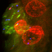 Nanoparticles in liver tumour, fluorescence micrograph