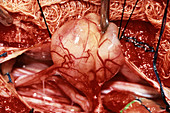 Spinal cord tumour removal