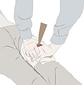 Foreign Body in Wound Dressing, illustration
